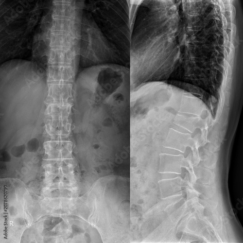 Bild auf Leinwand Radiographic Evaluation of Spinal Fractures: A Diagnostic Imaging Overview