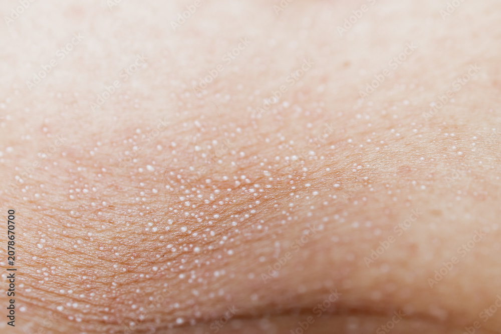 Fototapeta premium Macro close up of sweat droplets on human skin texture, perspiration pores or heat rash condition, medical and wellness concept