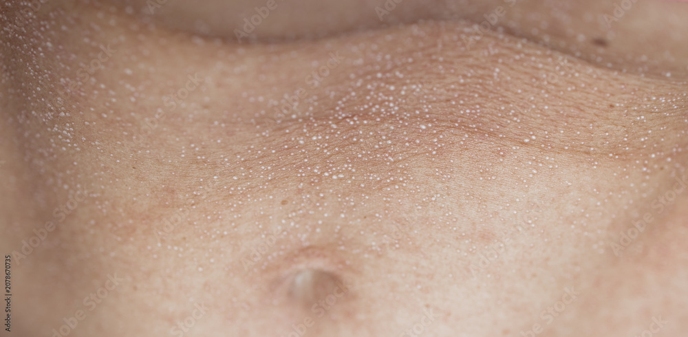Fototapeta premium Macro close up of sweat droplets on human skin texture, perspiration pores or heat rash condition, medical and wellness concept
