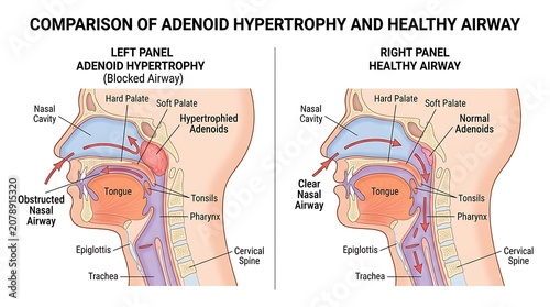 Comparison diagram showing obstructed airway from adenoid hypertrophy vs healthy