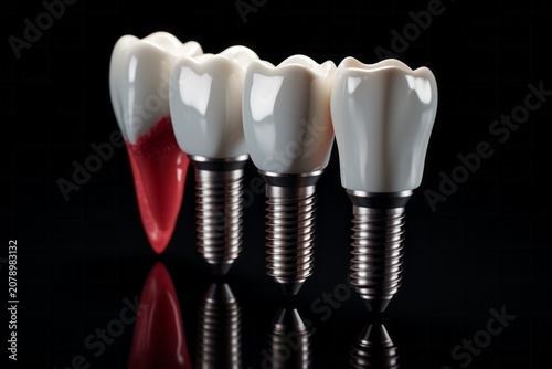 Dental implant, Dental care.  Dentists dental teeth implant . Dark Background