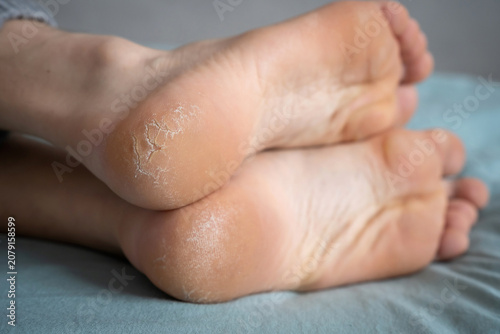 Foto Feet displaying serious cracked heels and dry, peeling skin, indicating a need f
