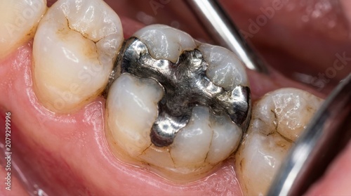 Dental Macro View of a Molar Tooth with Metal Amalgam Filling dirty teeth