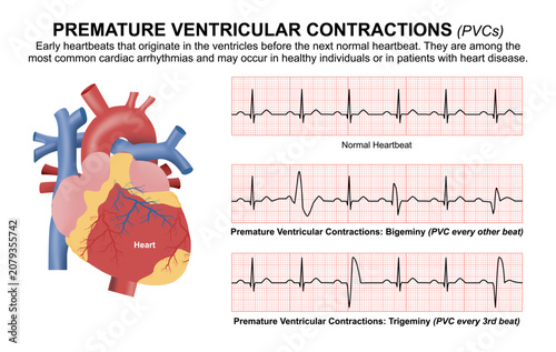Foto Premature Ventricular Contractions (PVCs) Illustration