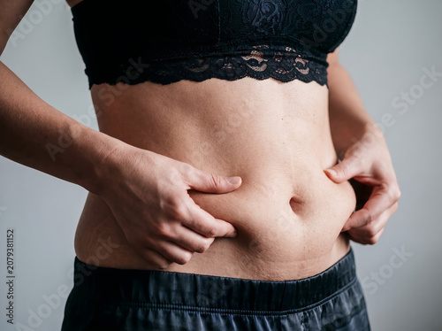 Close-up of a woman's hands pinching excess belly fat and stretch marks on her bare abdomen