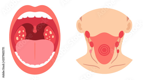 Fotografi Tonsillitis symptoms diagram with inflamed tonsils and throat