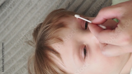 Close-up of the boy's face with a sadina. The child treats the wound on the face. A mother treats a child's scratch with antiseptic and anesthetic cream.