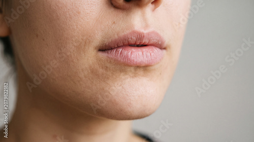 Closeup of a womans lower face showing dry chapped lips and skin irritation around the mouth
