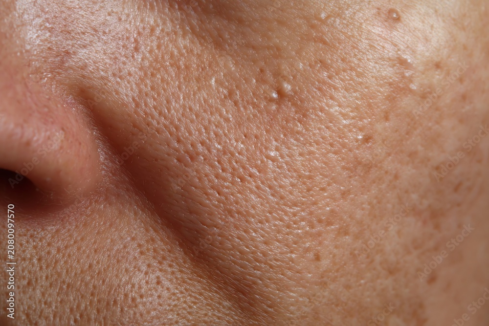 Fototapeta premium Macro Close Up of Whiteheads on Facial Skin