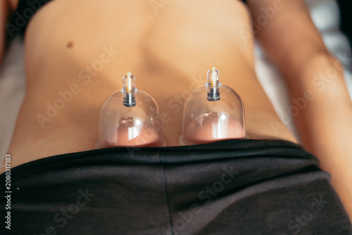 Фотография A person receives vacuum cupping therapy on their lower back in a well-lit therapy room