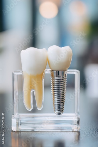 Dental implant model compared with a natural tooth in a transparent plastic holder, close up of titanium screw structure with crown for dentistry education and stomatological clinic concept