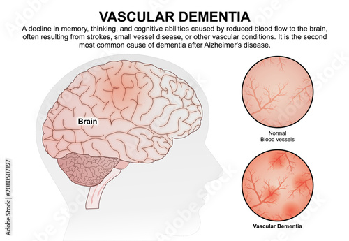 Vascular Dementia, Brain Flashcard Illustration