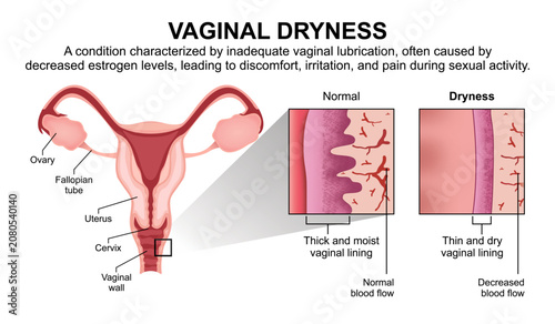 Bild auf Leinwand Vaginal Dryness, Vaginal Flashcard Illustration