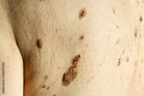 Human skin showing multiple moles and nevus