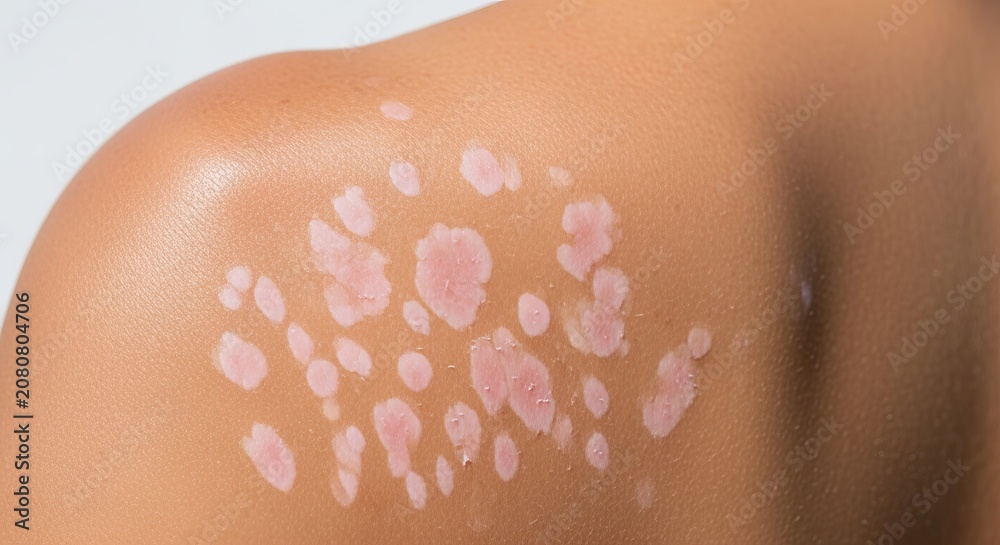 Fototapeta premium Photorealistic image of hypopigmented skin patches on back and shoulder illustrating skin condition