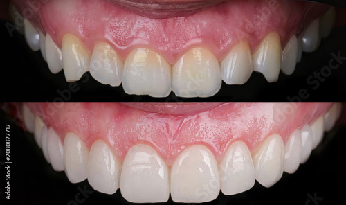 Dental smile design and Hollywood smile. Aesthetic treatment of crooked and deformed teeth using porcelain veneers, aesthetic fillings, and zirconium crowns.