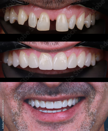 Dental smile design and Hollywood smile. Aesthetic treatment of crooked and deformed teeth using porcelain veneers, aesthetic fillings, and zirconium crowns.