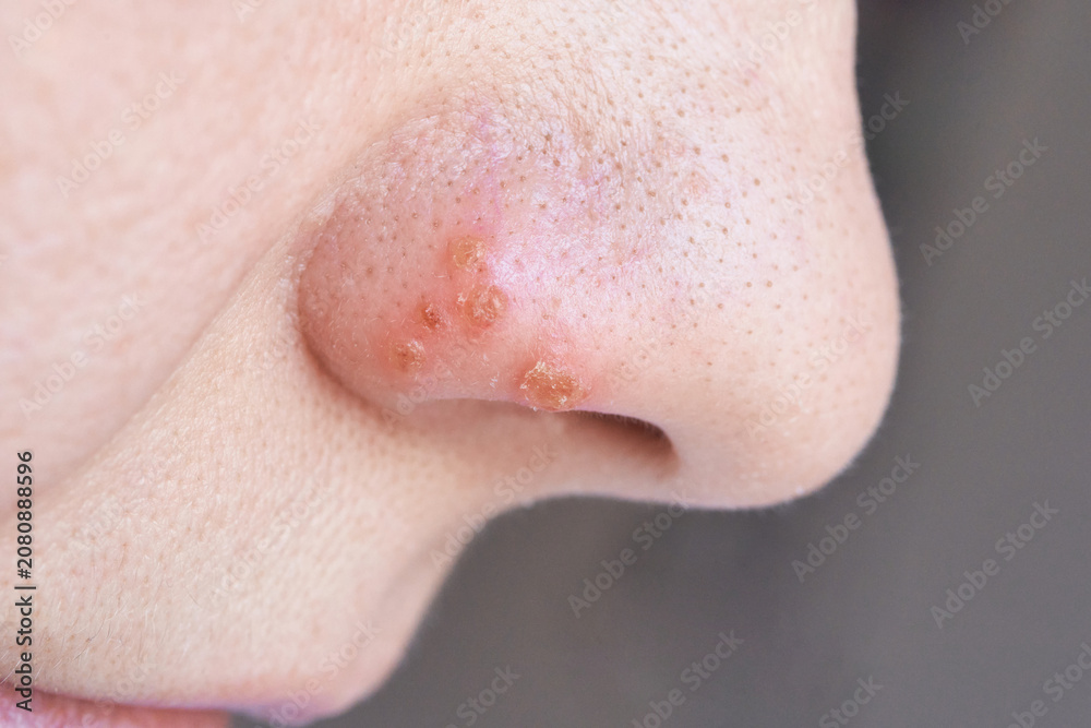 Naklejka premium Nose Profile With Crusted Scabs And Inflamed Pores On Nostril Closeup Showing Brownish Crusts And Surrounding Textured Skin In Neutral Lighting Clinical Dermatology Context.