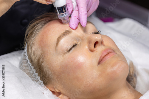 Professional hydradermabrasion facial treatment using a vacuum skincare device on the forehead. Deep cleansing, exfoliation and skin rejuvenation in a modern beauty clinic.