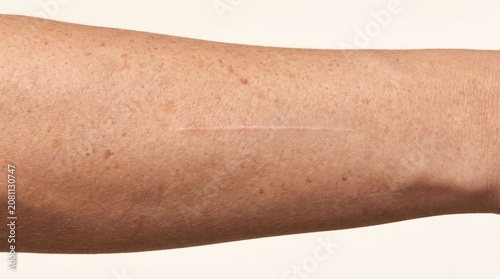 Fine linear scar on a freckled forearm skin close up