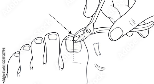 фотографія Proper technique for cutting an ingrown toenail with nail clippers