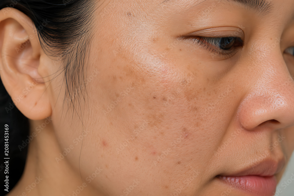 Fototapeta premium Hyperpigmentation on Right Cheek of Asian Woman Close Up with Natural Skin Textur