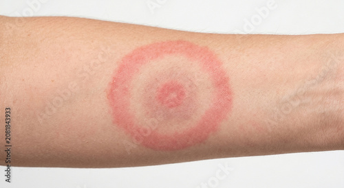 Foto Erythema Migrans (Lyme Disease) - Macule in Human Skin — Medical Dermatology Pla