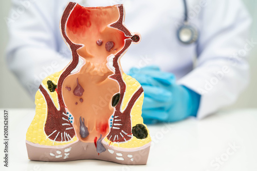 Fotografie Asian doctor with rectum and hemorrhoid human anatomy model at hospital, inflamed vascular structure