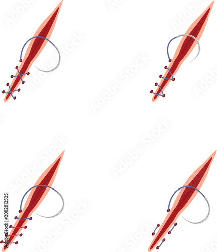 Wound with surgical needle and thread closing the incision