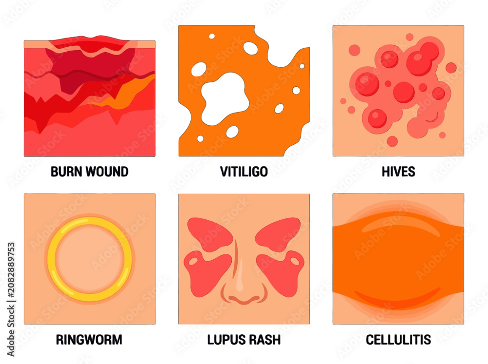 Fototapeta premium Medical infographic showing common skin conditions including burn wounds vitiligo hives ringworm lupus rash and cellulitis in a flat vector illustration