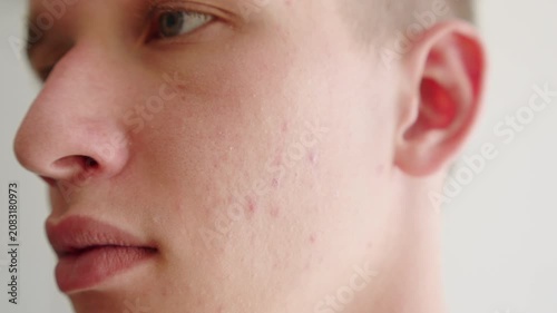 Close-up of a young man’s cheek with acne breakouts, skin texture blemishes. Men touching his face with red inflammatory papules. Men’s skin care.