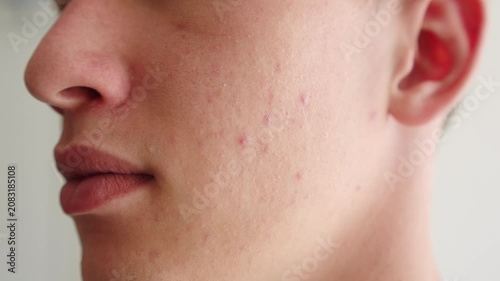 Close-up of a young man’s cheek with acne breakouts, skin texture blemishes, and red inflammatory papules. Mam with pimples on his face.