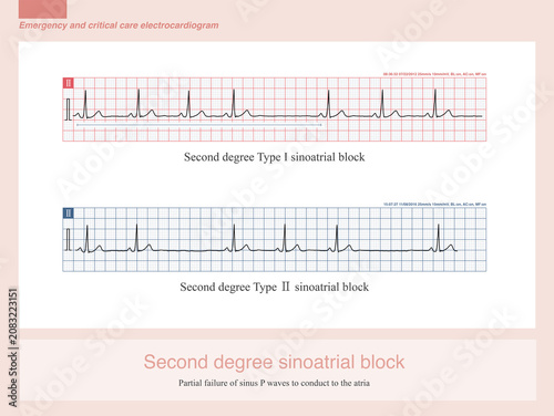 Second degree sinoatrial block refers to a condition in which sinus impulses are only partially conducted to the atria; this results in the appearance of sinus P waves on the ECG, while the blocked co