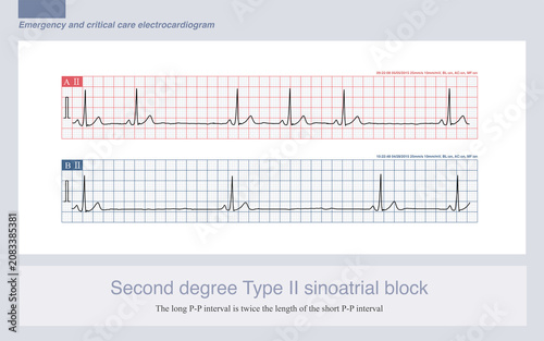 In second degree Type II sinoatrial block, sinus impulses are partially conducted to the atria and partially blocked, with the long P-P interval being twice the length of the short P-P interval.
