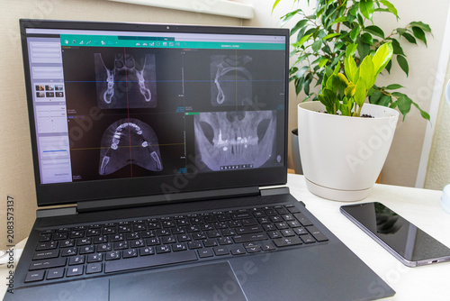Black laptop computer screen displaying dental 3D CBCT tomography diagnostic software on a home office desk with houseplants. Healthcare