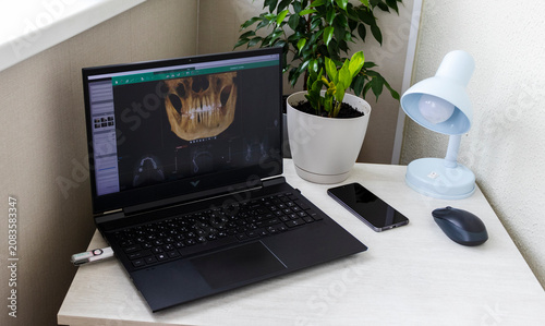 Vászonkép Laptop screen displaying professional dental diagnostic software with a 3D panoramic jawbone model and cross-sectional root slices