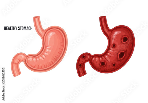 vector illustration of healthy vs. unhealthy human stomach anatomy, showing ulcers, severe acid erosion, and inflammation on a white background. clinical concept of digestive health