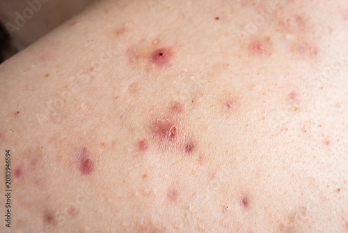 Принти на полотні Blemishes with redness on skin