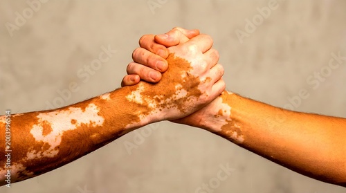 Two arms clasped together in a strong handshake grip, showcasing distinct vitiligo skin pigmentation patches, symbolizing unity, mutual support, diversity, and skin condition awareness.