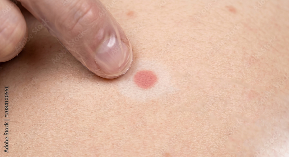 Fototapeta premium Typhoid Rose Spots in human skin - Macule in Human Skin — Medical Dermatology Plate (26-100)