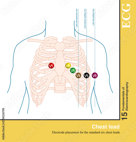 In a standard 12-lead electrocardiogram, there are six chest leads, with electrodes placed on the skin of the chest.
