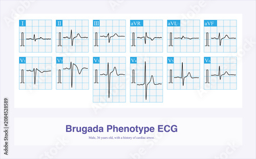 A 36 year old man survived CPR after sudden syncope. The electrocardiogram was suggestive of Brugada syndrome type 1. Finally, he was treated with an ICD.
