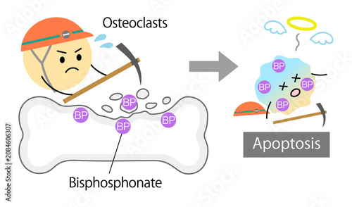 Photos Apoptosis of Osteoblasts induced by Bisphosphonates