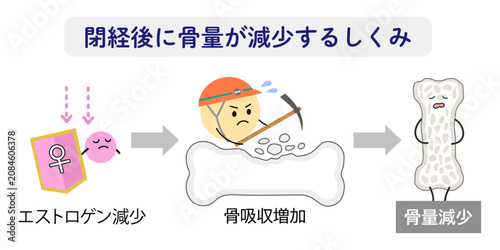 Fotografía 閉経後に骨量が減るしくみをあらわすイラスト