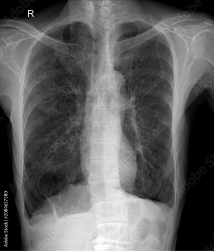 PA Chest X-ray Radiograph Showing Hyperinflated Lungs