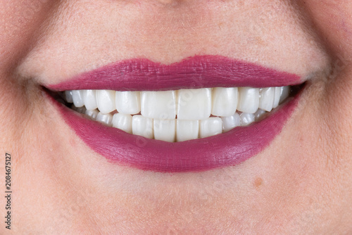 ceramic crowns and veneers