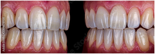 ceramic crowns and veneers