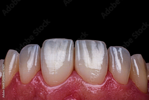ceramic crowns and veneers