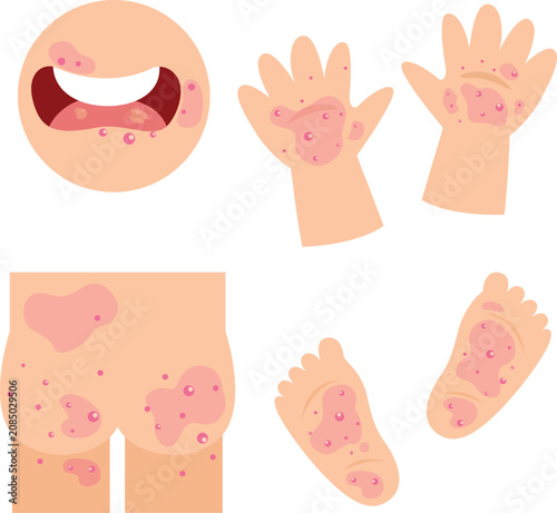 Hand, Foot and Mouth Disease in Children Illustration