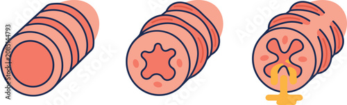 Bild auf Leinwand Human Bronchi Cross Section Diagram Showing Progressive Asthma Stages with Norma